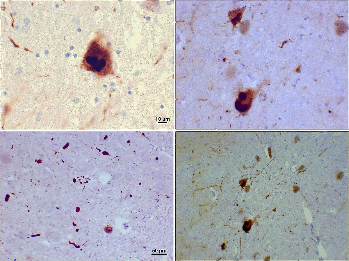 Demence není jen Alzheimer. Čeští vědci se snaží včas odhalit i zrádné onemocnění s Lewyho tělísky